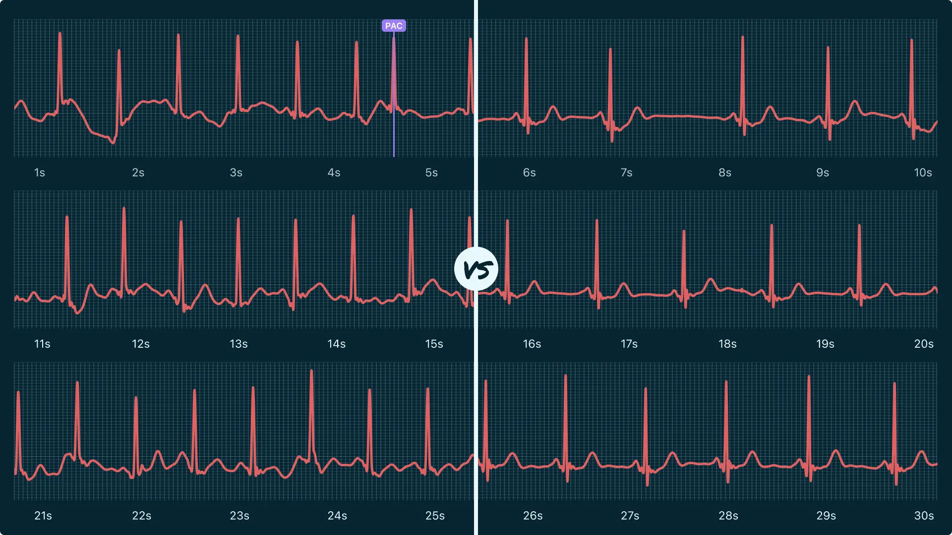 Premature Atrial Contraction (Single) Vs. Sinus Pause <3